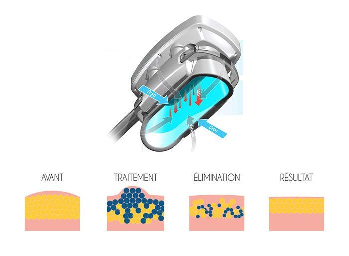 Soin minceur cryolipolyse résultat