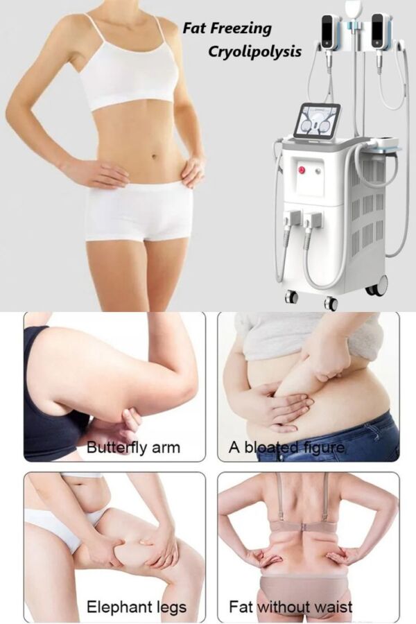 Soin minceur cryolipolyse résultat