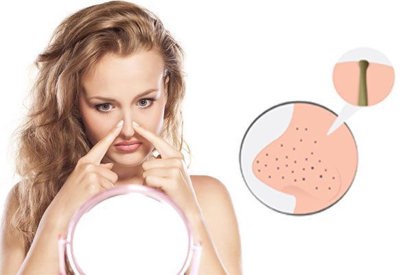 Soins visage à cannes : découvrez l’extraction professionnelle des points noirs chez my body center