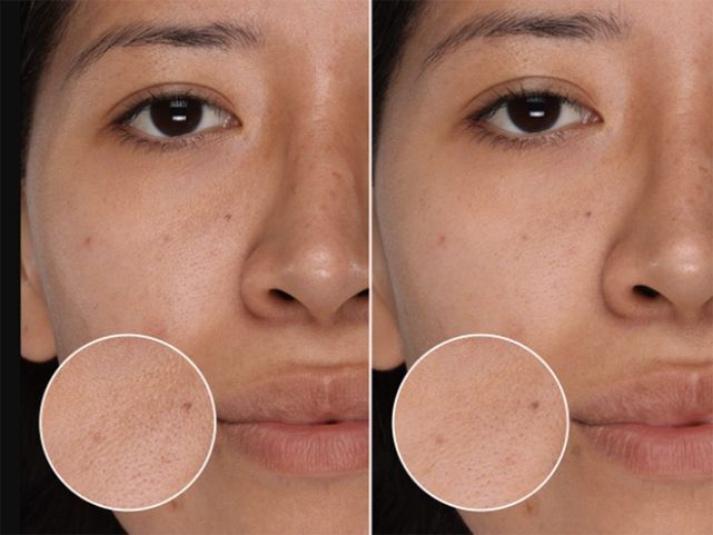 extraction points noirs cannes