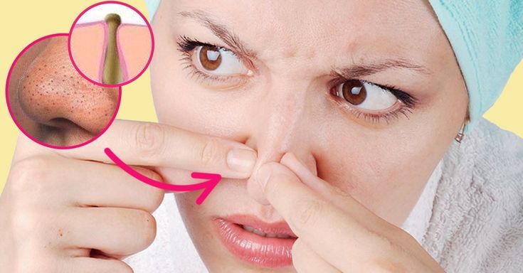 Soin visage extraction comédons professionnel