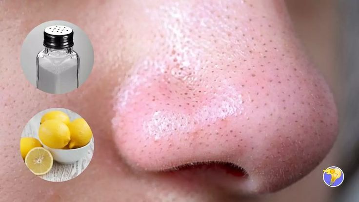 extraction points noirs cannes